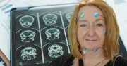 Pioneering Brain Drug Shows Promise in Slowing Parkinson's Progression