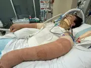 Robot vacuum explosion leaves man with 75% burns in Australia