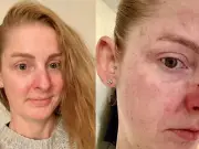 Rosacea Sufferers Praise Kalme Cream That 'Took Redness From My Face in Days'