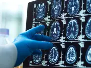 Shrunken Amygdala Linked to Cold-Blooded Murder, Study Finds