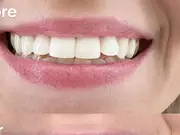 Tea Drinker, 60, Gets Whiter Teeth with £25 MySweetSmile Powder