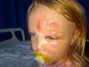 Toddler Fractures Skull in Nursery Fall, Ofsted Suspends Provider
