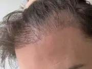 Turkey Hair Transplant Cost Man £9,000 and Years of Misery