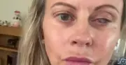 UK Mum's Eye Eaten by Parasites After Washing Face with Contact Lenses