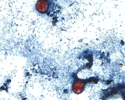 US Cyclospora Outbreak Surpasses 2,800 Cases Amid Funding Cuts