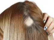 Weight loss drugs linked to increased risk of hair loss, study finds