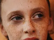 Why Freckles Appear and Get Darker in Summer: GP Explains