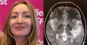 Woman had 38 brain parasites after India trip, battled seizures and psychosis