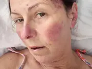 Woman Mistook Leukaemia Symptoms for Menopause, Then Fought for Life