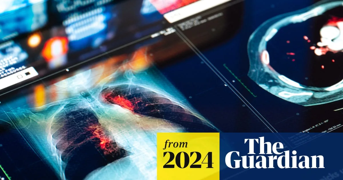 World-first urine test could detect lung cancer years early