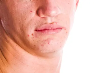 DWP confirms 25 skin conditions for £114 weekly PIP payment