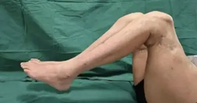 Factory worker's legs reattached in world first after being sliced in half
