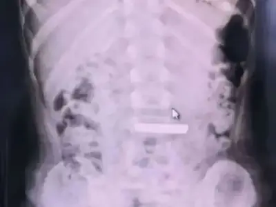 Girl, 5, hospitalised after swallowing £5,300 gold bar