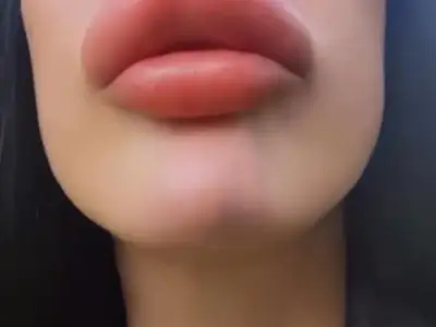 Manchester woman injects own lip filler despite safety warnings