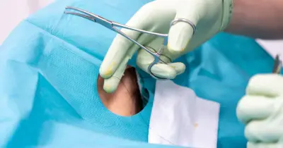 NHS surgeon struck off after catastrophic bowel surgery error