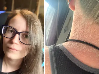 NHS worker's psoriasis 'nearly gone' after £11 Amazon cream