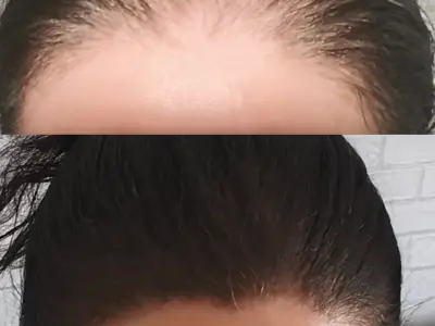 Red Light Gadget with £100 Off Boosts Hair Thickness