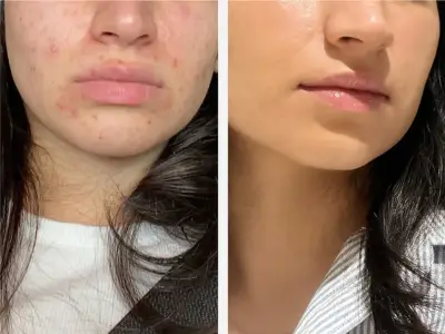 Spot sufferers praise £30 Dr Sam's gel as 'Holy Grail' skincare saviour