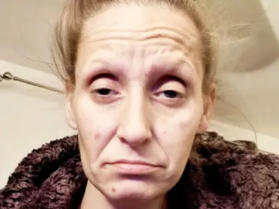 Woman addicted to camping gas pulls out all her teeth