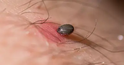 Woman in coma for six weeks after tick bite on holiday