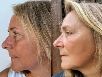 Woman's hair fell out in handfuls but is thicker again with vegan £1-a-use buy