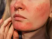 £13 cream hailed as 'best product' for rosacea redness in a week