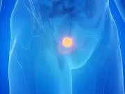 26,000 waiting for bladder cancer checks despite home test
