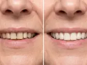 Bank Holiday Sale: 30% Off MySweetSmile Teeth Whitening Range