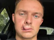 Champion Jockey Sean Bowen Posts Graphic Picture After Kick to Face