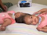 Conjoined twins die after final stage of complex separation surgery