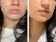 Dermatologist's £30 gel gives spot sufferers 'confidence to be makeup free'