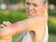 Insect bite hospital visits double as heatwaves hit UK