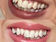 Manchester Dentist's Teeth Whitening Powder Boosts Confidence