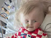 Mum misses son's football-sized noggin after skull reduction surgery