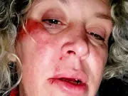 Mum-of-four loses seven teeth in pothole fall and wants compensation