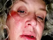 Mum Suffers Life-Changing Injuries After Tripping on Pothole