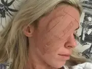 Mum's 'pimple' was skin cancer; she fights to cut sun cream VAT