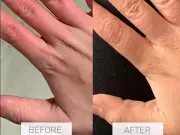 Nursem's £10 cream 'cleared up 10 years of hand psoriasis'