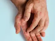 Psoriasis Sufferer Praises £13 Mānuka Honey Skincare Dupe