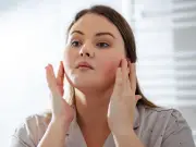 Rosacea Cream Praised by Users for Boosting Confidence