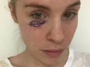 Skin cancer survivor, 34, takes 99k-signature sunscreen VAT petition to No10