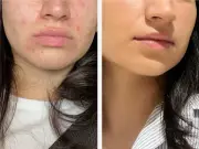 Spot sufferers praise £30 Dr Sam's gel as 'Holy Grail' skincare saviour