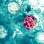 Two deaths linked to US cyclosporiasis outbreak