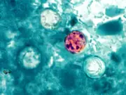 UK warns of sharp rise in cyclospora cases from Mexico travel