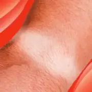 Watch Rot: The Summer Skin Irritation Mistaken for Tan Lines