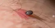 Woman in coma for six weeks after tick bite on holiday