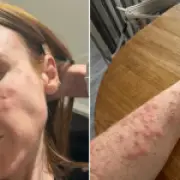 Woman wakes up covered in 100 bedbug bites at Travelodge