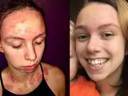 Woman's Psoriasis Transforms in Days with £12 Amazon Serum