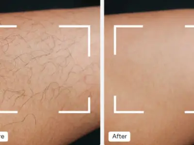 Keskine IPL Hair Removal Device Gets £169.65 Discount