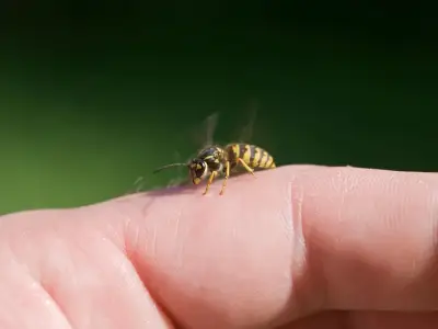Nurse warns of 9 serious symptoms after wasp or bee sting